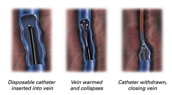 3step procedure Vnus