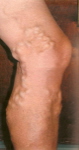 small varicose